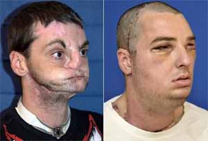 trapianto di volto completo