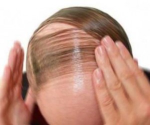 caduta-capelli-rimedio